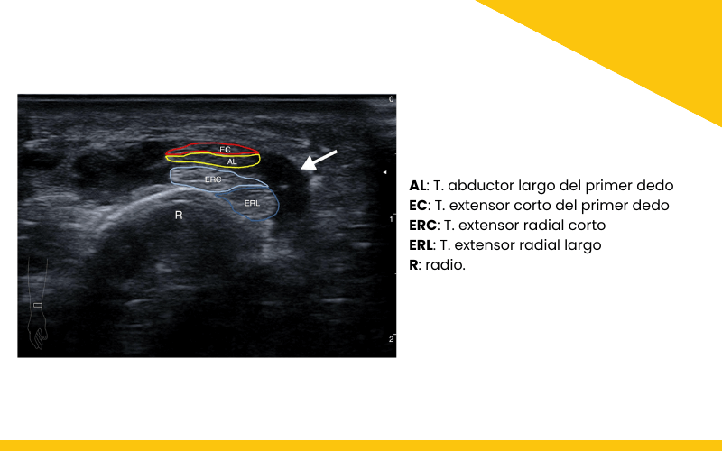 Sindrome interseccion distal ecografia tempo formacion 1.png